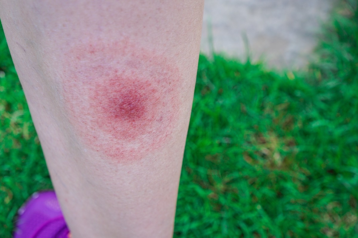 lyme disease rash