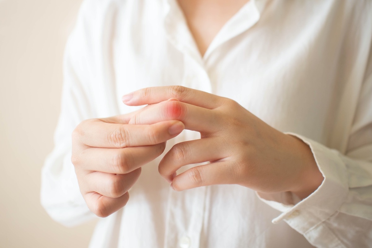 Young female​ suffering from hand and finger joint pain​ with​ redness.