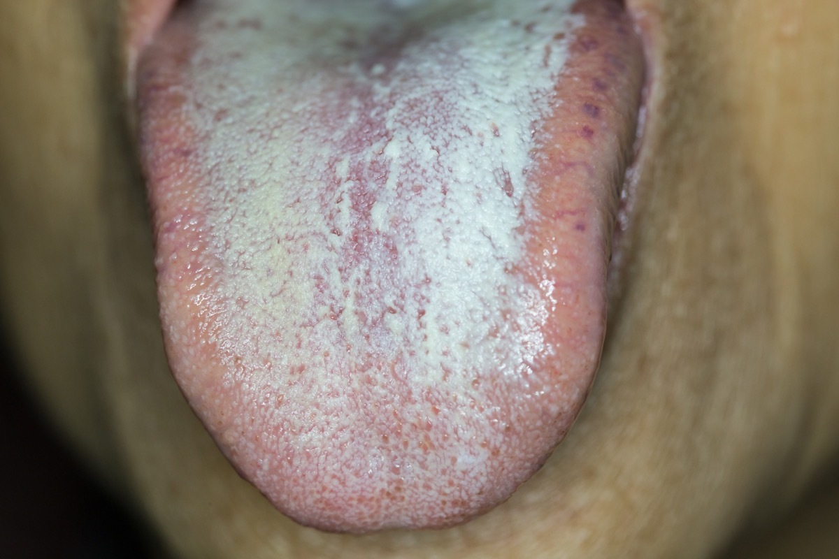 Person with a white tongue from diabetes tongue health