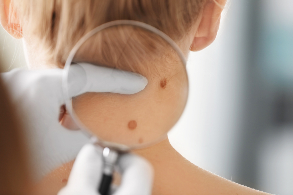 doctor using a magnifying glass to examine moles