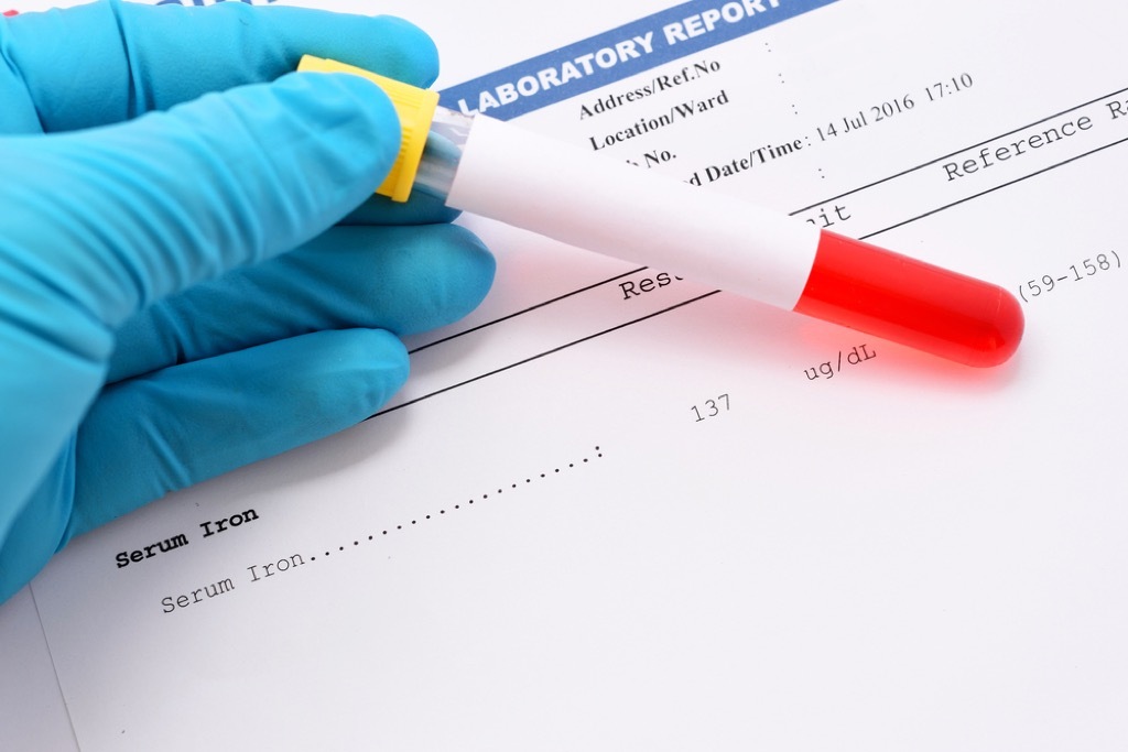 iron deficiency anemia