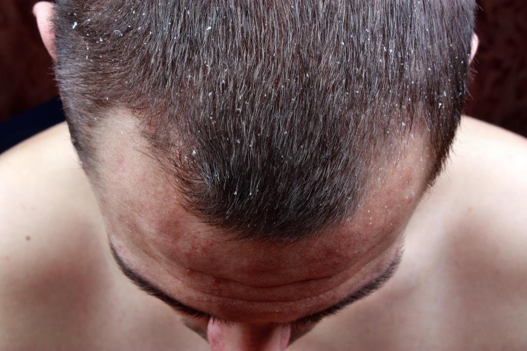 dry scalp dandruff hair