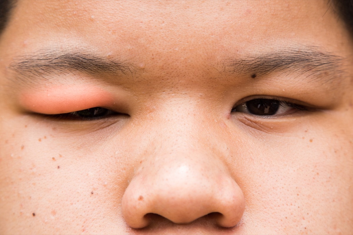 Boy with swollen eye