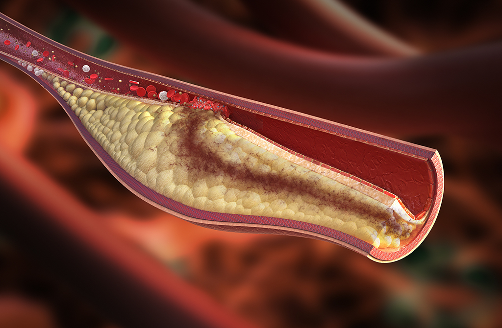 blood clot heart attack angioplasty