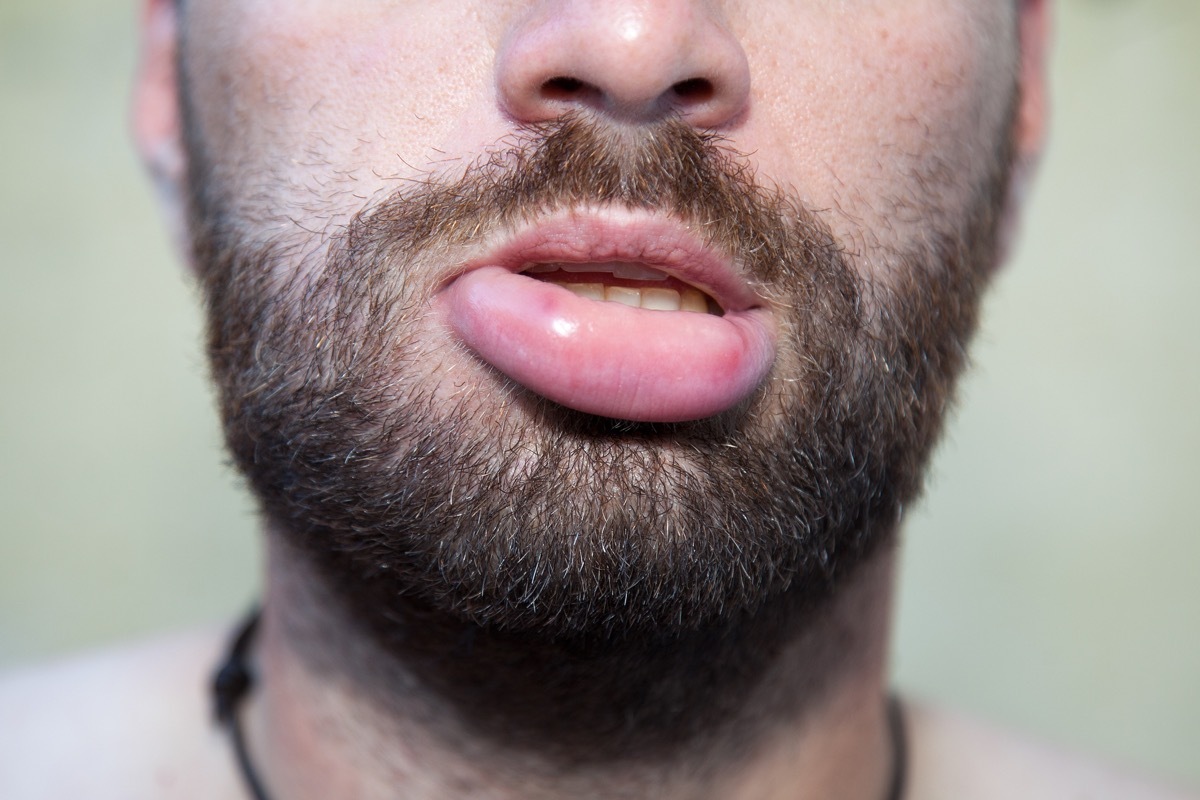 Man with swollen lip