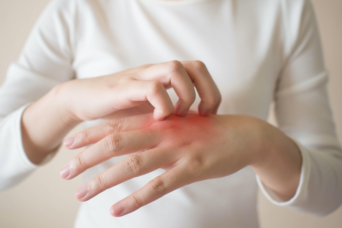 Young woman scratching the itch on her hands w/ redness rash.