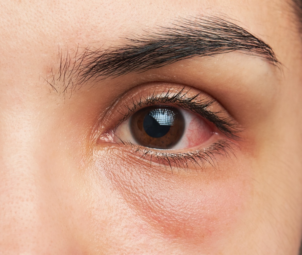 A woman's pink eye with infection.