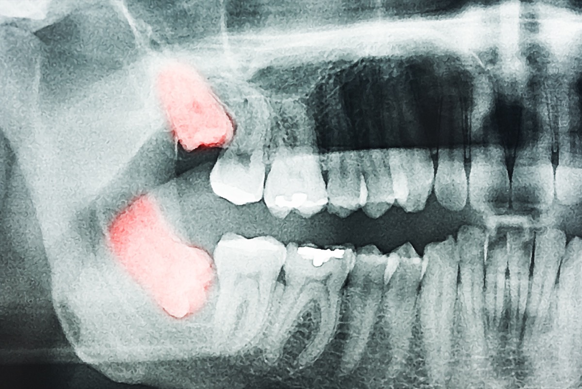 Growing Wisdom Teeth Pain On X-Ray