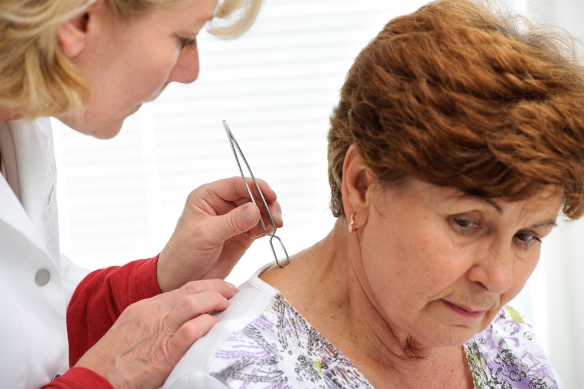 Doctor removing a tick with tweezers from skin of patient - Image